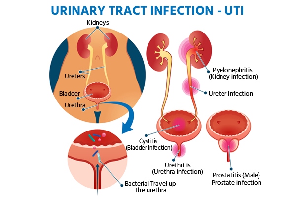 A urinary tract infection (UTI) is a common infection that can occur in any part of the urinary tract.